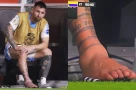 Chân của Messi bị làm sao vậy?