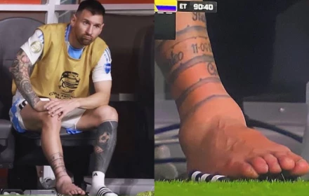 Chân của Messi bị làm sao vậy?