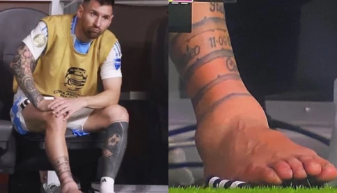 Chân của Messi bị làm sao vậy?