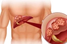 Đừng đợi vàng da mới đi khám: Đây là 8 dấu hiệu gan đang "kêu cứu"