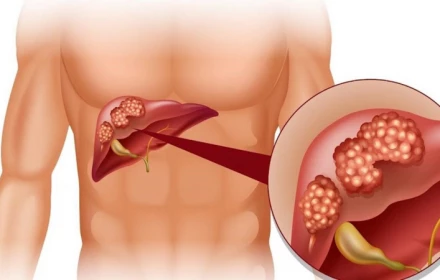 Đừng đợi vàng da mới đi khám: Đây là 8 dấu hiệu gan đang "kêu cứu"
