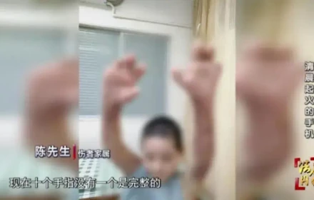 Một người phụ nữ bị bỏng nặng khắp cơ thể, bao gồm cả mười ngón tay, khi đang dùng điện thoại sạc pin trên giường