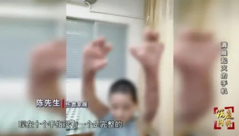 Một người phụ nữ bị bỏng nặng khắp cơ thể, bao gồm cả mười ngón tay, khi đang dùng điện thoại sạc pin trên giường