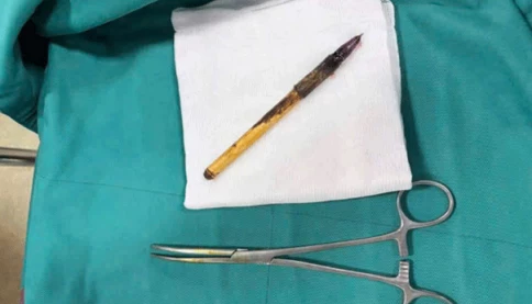 Vụ nam sinh lớp 6 phải phẫu thuật lấy bút trong trực tràng: Sức khỏe đã cải thiện, cơ quan chức năng tiếp tục làm rõ