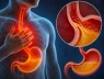 Trào ngược dạ dày thực quản gây hôi miệng phải làm gì?