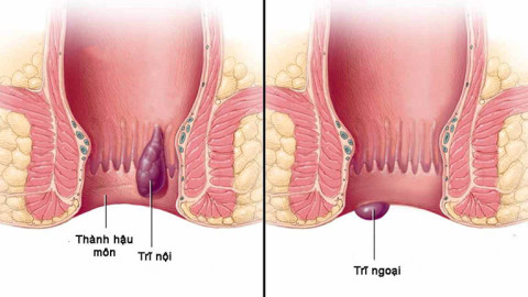 Phòng ngừa bệnh trĩ như thế nào?