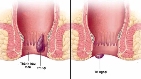 Phòng ngừa bệnh trĩ như thế nào?
