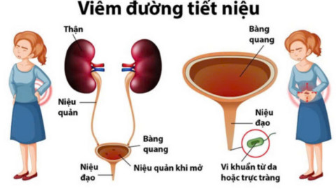 Nhiễm trùng tiết niệu ở phụ nữ tiền mãn kinh: Hiểu để bảo vệ sức khỏe từ gốc