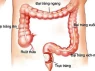 Nam sinh 22 tuổi mắc ung thư đại tràng giai đoạn 4 sau khi bỏ qua 3 dấu hiệu bất thường suốt nửa năm