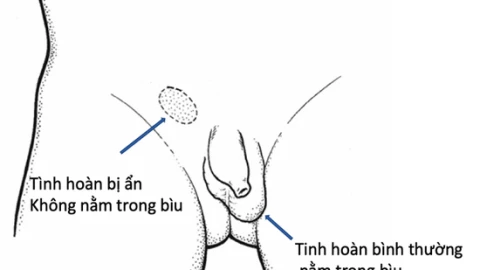 Tinh hoàn ẩn và nguy cơ vô sinh ở nam giới: Các dấu hiệu cần lưu ý