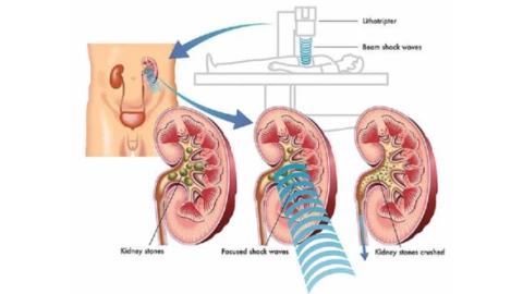 Tán sỏi ngoài cơ thể - Giải pháp hiện đại cho người bị sỏi thận