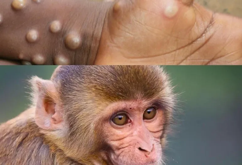 thumbnail - Bệnh đậu mùa khỉ và hiểm họa khôn lường đối với sức khỏe tim mạch 