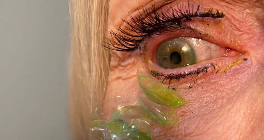 Bác sĩ gắp ra 23 kính áp tròng bị bỏ quên trong mắt bênh nhân