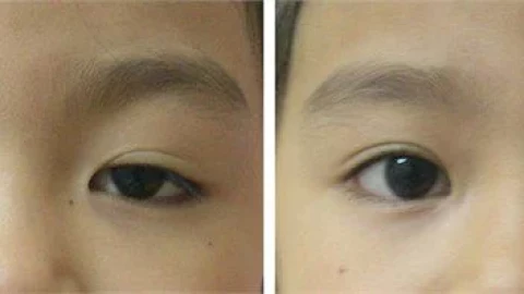 Theo dõi và chăm sóc bệnh nhân sau mổ treo mi do sụp mi bẩm sinh mức độ nặng