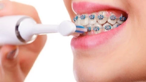 Chăm sóc răng miệng khi niềng răng: Những điều cần lưu ý