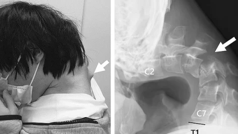 Hình ảnh cổ vẹo vọ đáng sợ của nam thanh niên vì sở thích quen thuộc
