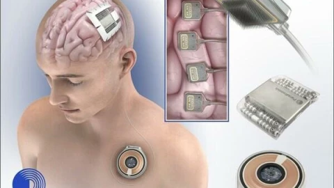 Đối thủ của Neuralink cấy chip não thành công trên người, cuộc đua chip não càng thêm nóng