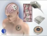 Đối thủ của Neuralink cấy chip não thành công trên người, cuộc đua chip não càng thêm nóng