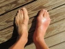 7 yếu tố làm tăng nguy cơ mắc bệnh gout