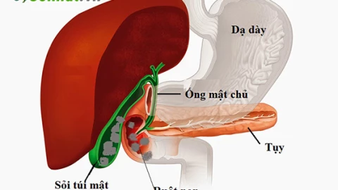 Sỏi túi mật gây tắc ruột: Hiểm họa âm thầm khó lường