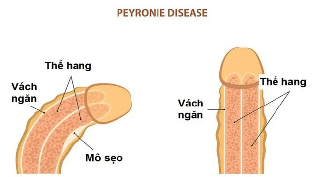 Cong dương vật ảnh hưởng thế nào tới quan hệ tình dục?