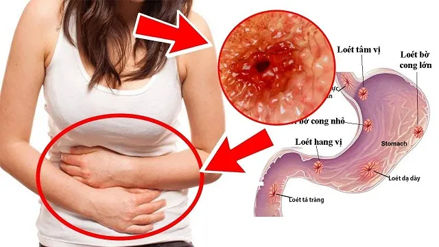 4 loại thực phẩm hỗ trợ chữa vết loét dạ dày, tá tràng