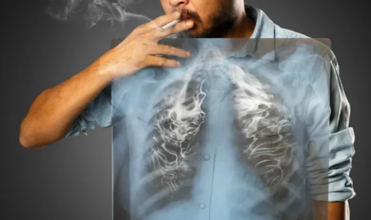 Tại sao có người hút thuốc lá ít vẫn bị ung thư phổi, còn người nghiện thuốc lá nặng lại không bị?