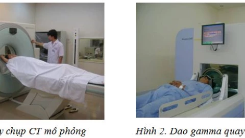 Xạ phẫu bằng dao gamma quay: Giải pháp đột phá trong điều trị u não và các bệnh lý sọ não