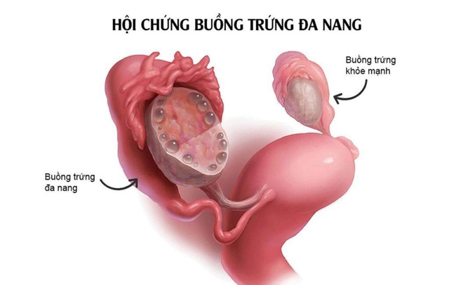 Các lý do phụ nữ có thể bị vô sinh thứ phát sau khi sinh con đầu lòng