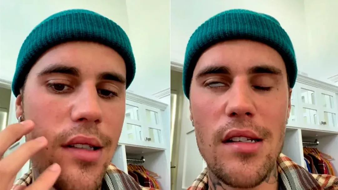 thumbnail - Virus khiến Justin Bieber bị liệt cơ mặt nguy hiểm thế nào?