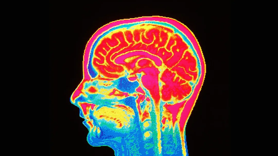 Nhiều người vẫn nhầm giữa Alzheimer và sa sút trí tuệ, thế chúng khác gì nhau?