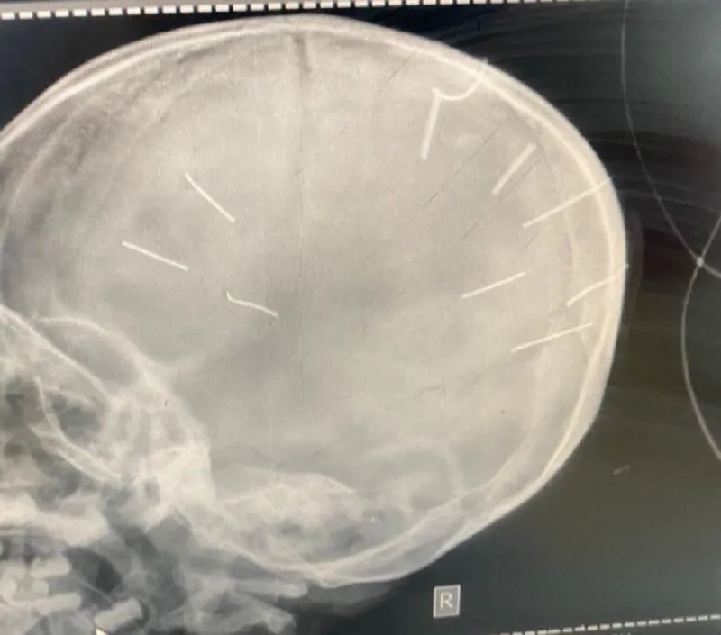 Bé gái 3 tuổi bị 9 đinh găm trong đầu ở Thạch thất: Thông tin mới nhất