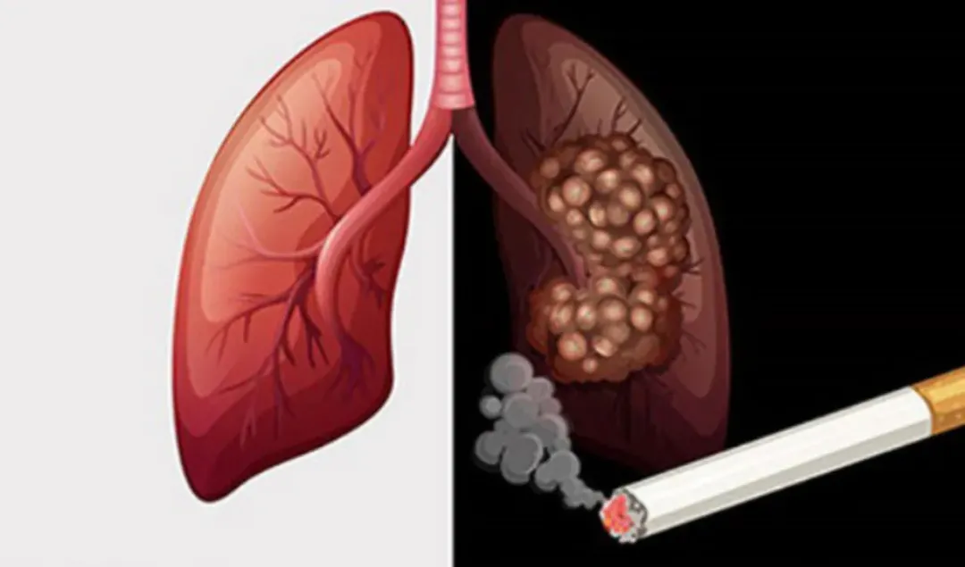 thumbnail - Tại sao nhiều người nghiện thuốc lá nặng vẫn không bị ung thư phổi?