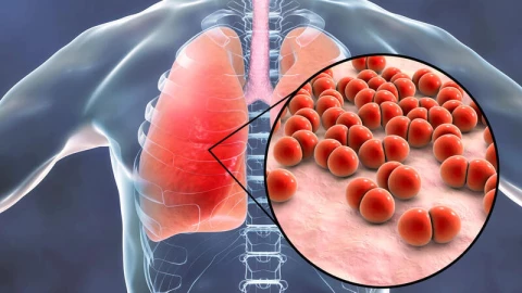 Bệnh phổi kẽ (Interstitial lung disease) một căn bệnh nguy hiểm còn ít được quan tâm