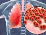 Bệnh phổi kẽ (Interstitial lung disease) một căn bệnh nguy hiểm còn ít được quan tâm