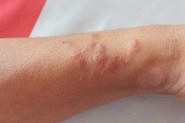 Loài giun ký sinh này có thể vô hiệu hóa cảm giác đau và ngứa của bạn