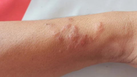 Loài giun ký sinh này có thể vô hiệu hóa cảm giác đau và ngứa của bạn