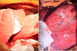 Đột phá trong việc sử dụng phổi lợn cấy ghép cho người