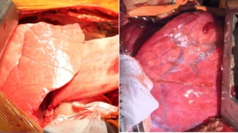 Đột phá trong việc sử dụng phổi lợn cấy ghép cho người