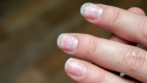 5 dấu hiệu trên móng tay cảnh báo thiếu vitamin nghiêm trọng