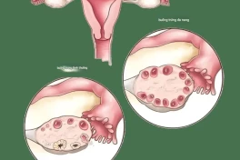 Hội chứng buồng trứng đa nang (PCOS): "kẻ giết người vô hình" của phụ nữ trong độ tuổi sinh đẻ, bạn biết bao nhiêu?