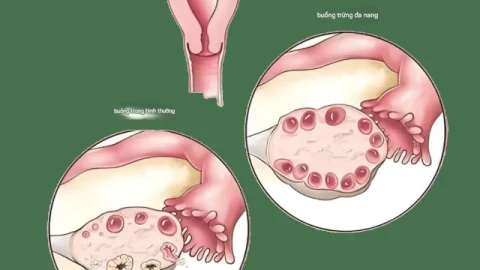 Hội chứng buồng trứng đa nang (PCOS): "kẻ giết người vô hình" của phụ nữ trong độ tuổi sinh đẻ, bạn biết bao nhiêu?