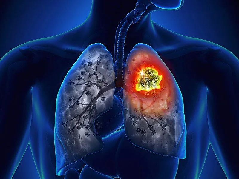 2 biểu hiện của ung thư phổi được cơ thể gửi tín hiệu ra ngoài, đừng coi thường