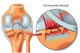 Rách dây chằng có liền lại không?