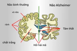 Dinh dưỡng giúp ngăn ngừa bệnh Alzheimer theo nghiên cứu mới nhất