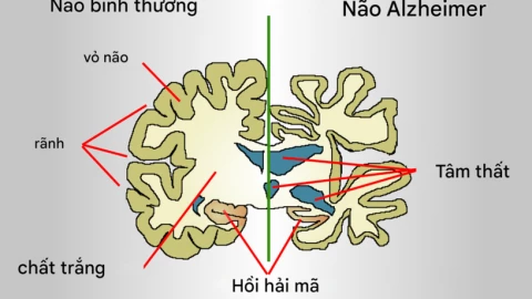 Dinh dưỡng giúp ngăn ngừa bệnh Alzheimer theo nghiên cứu mới nhất