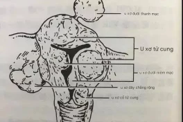 Những biến thể bất ngờ của u xơ tử cung và sự bí ẩn của khối u không xác định