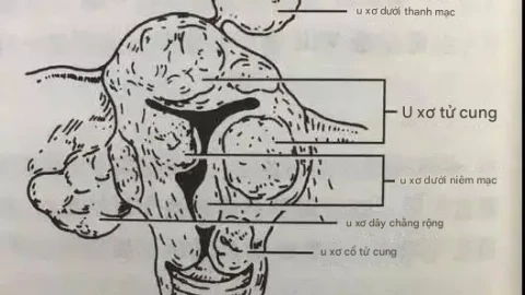 Những biến thể bất ngờ của u xơ tử cung và sự bí ẩn của khối u không xác định