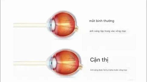 Vì sao cận thị và lão thị xuất hiện cùng lúc? Cách xử lý thế nào?
