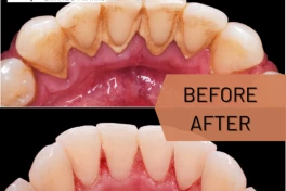 Thời điểm vàng để làm trắng răng mà ít ai biết đến